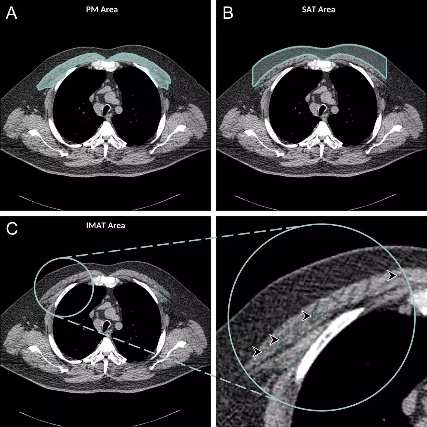 Chest CT illuminates mortality risk in people with COPD