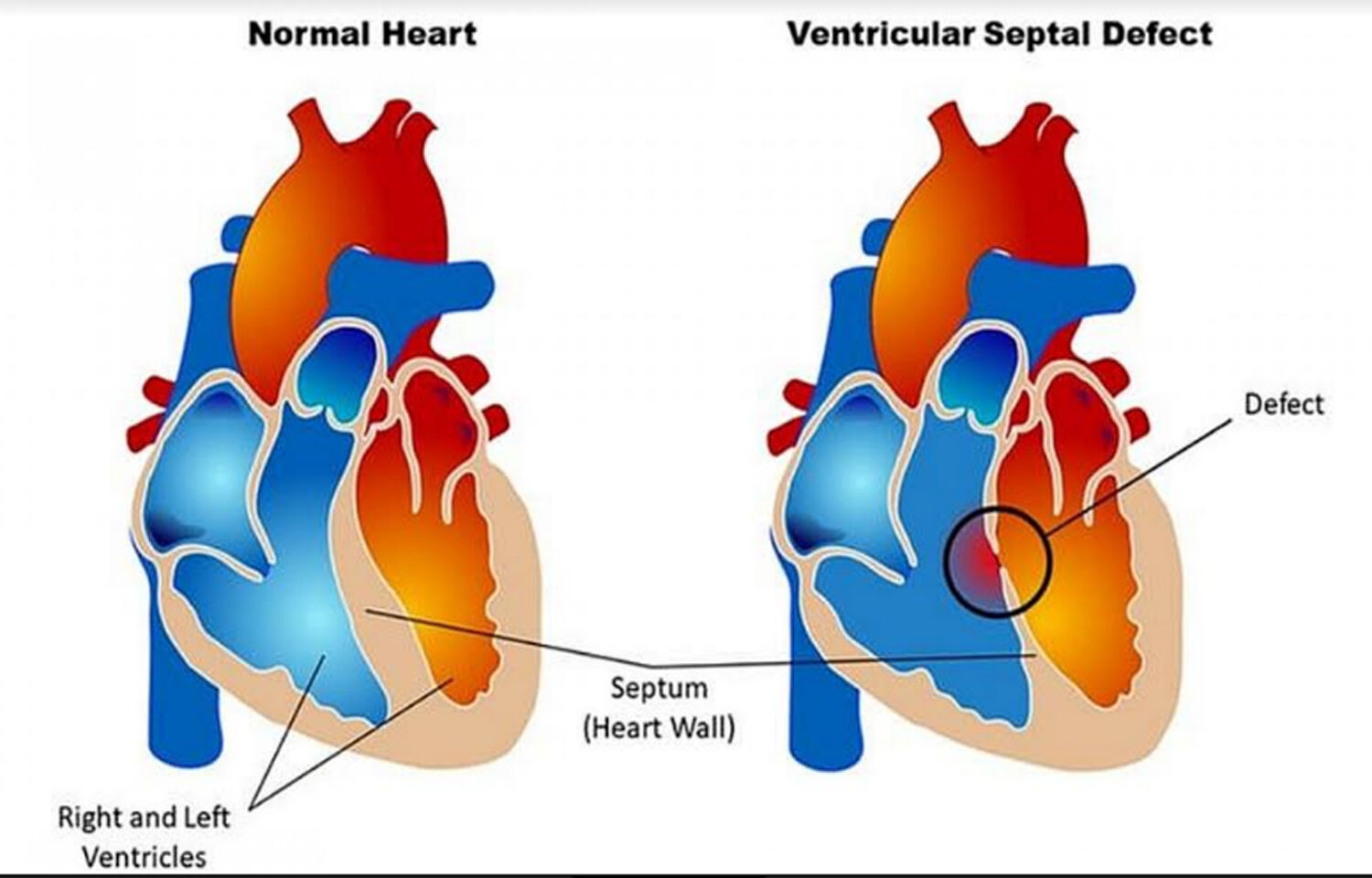 surgery-for-congenital-heart-disease-tied-to-adult-hypertension-risk-jama