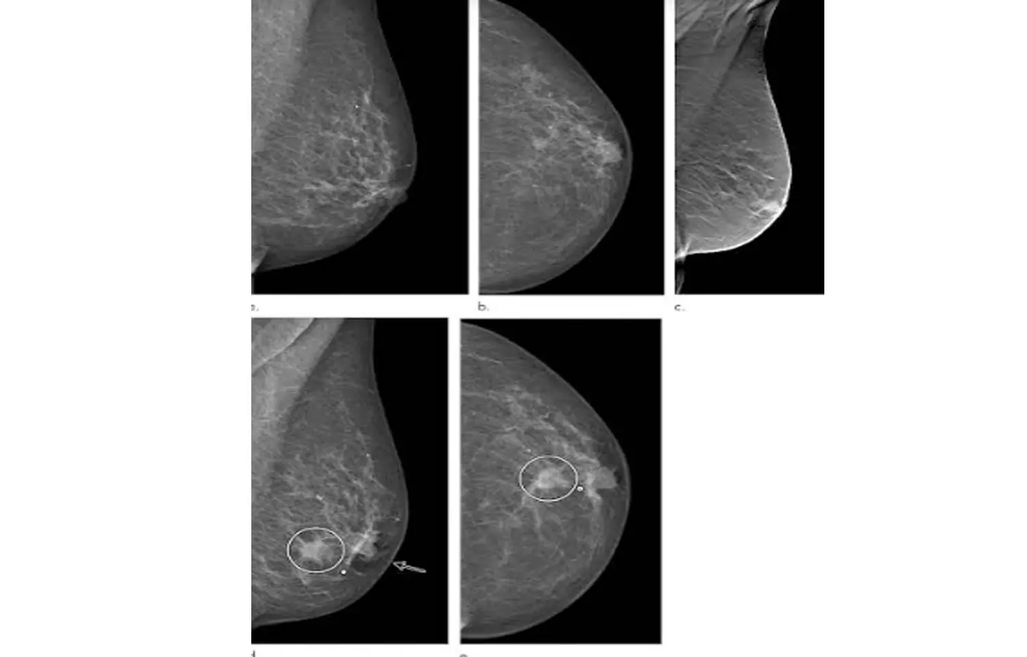 Hidden breast cancer after breast augmentation diagnosed by colour Doppler: BMJ case report