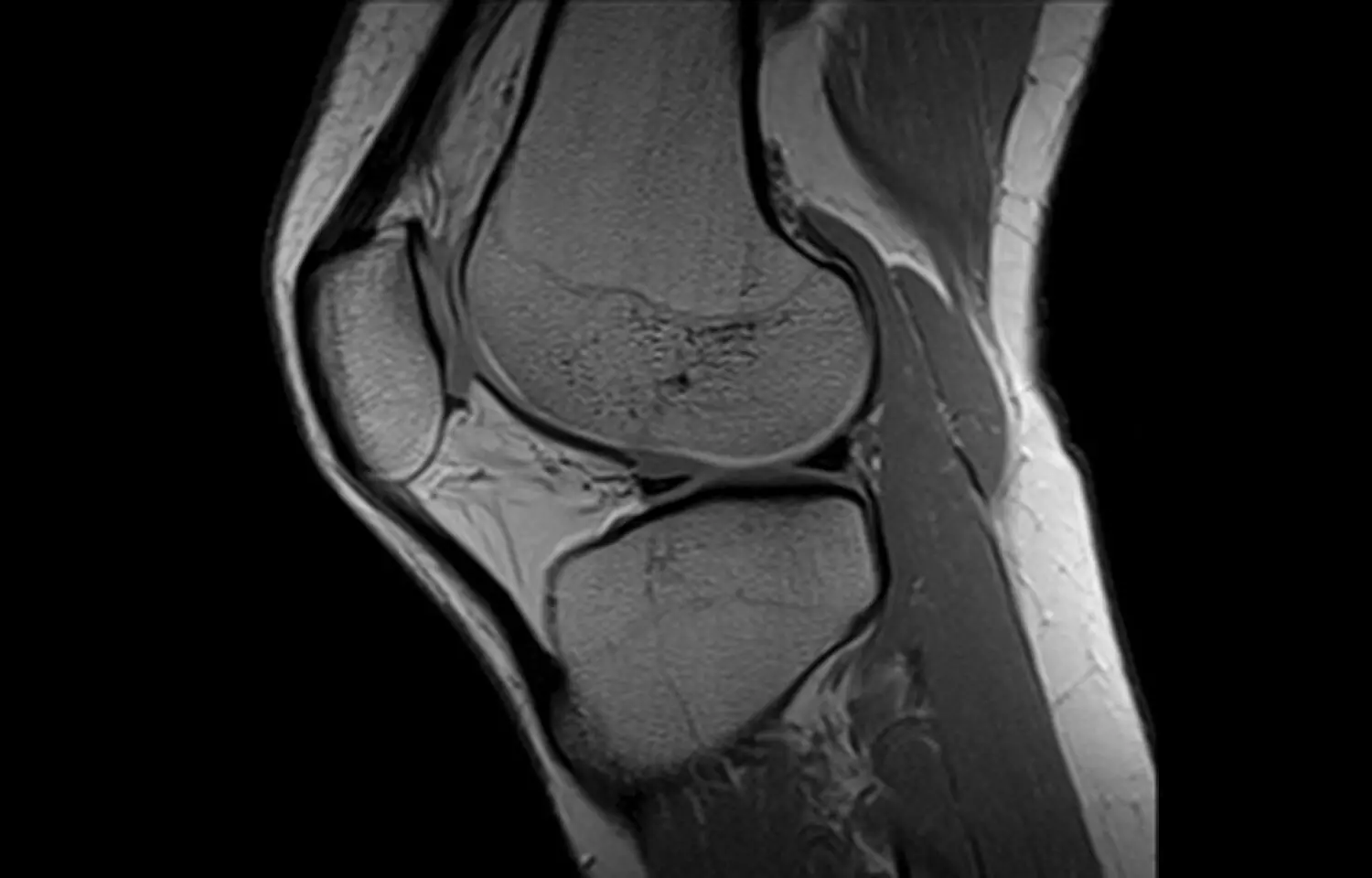 5-minute knee MRI performs equally well as 10-minute protocol: Study