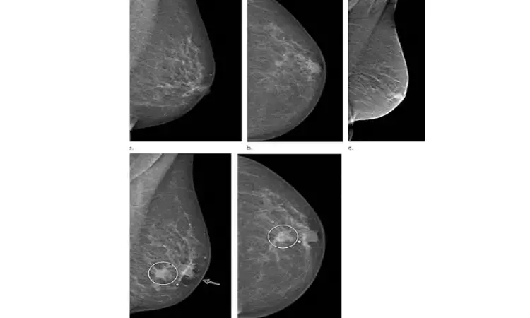 Hidden breast cancer after breast augmentation diagnosed by colour Doppler: BMJ case report