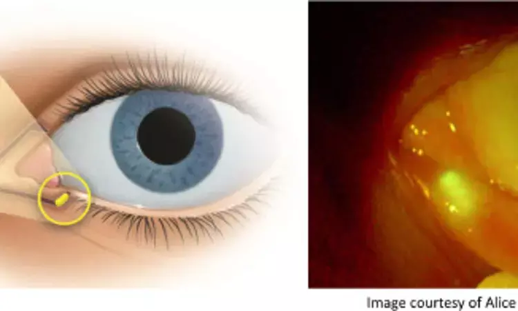 Dexamethasone Insert easy alternative for Treatment of Ocular Inflammation After Cataract/Cornea Surgery