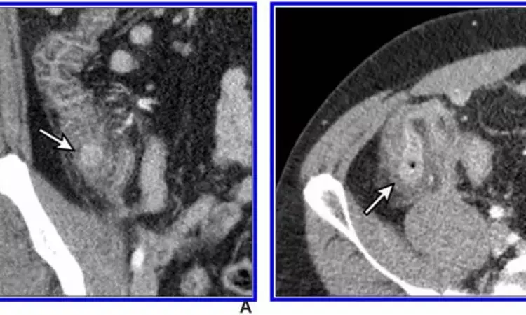 Low-dose CT for right colonic diverticulitis an alternate diagnosis of appendicitis