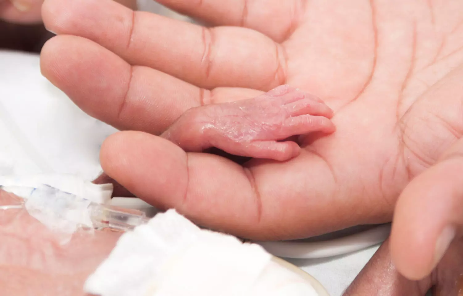 Delaying umbilical cord clamping saves babies lives, confirms Lancet study