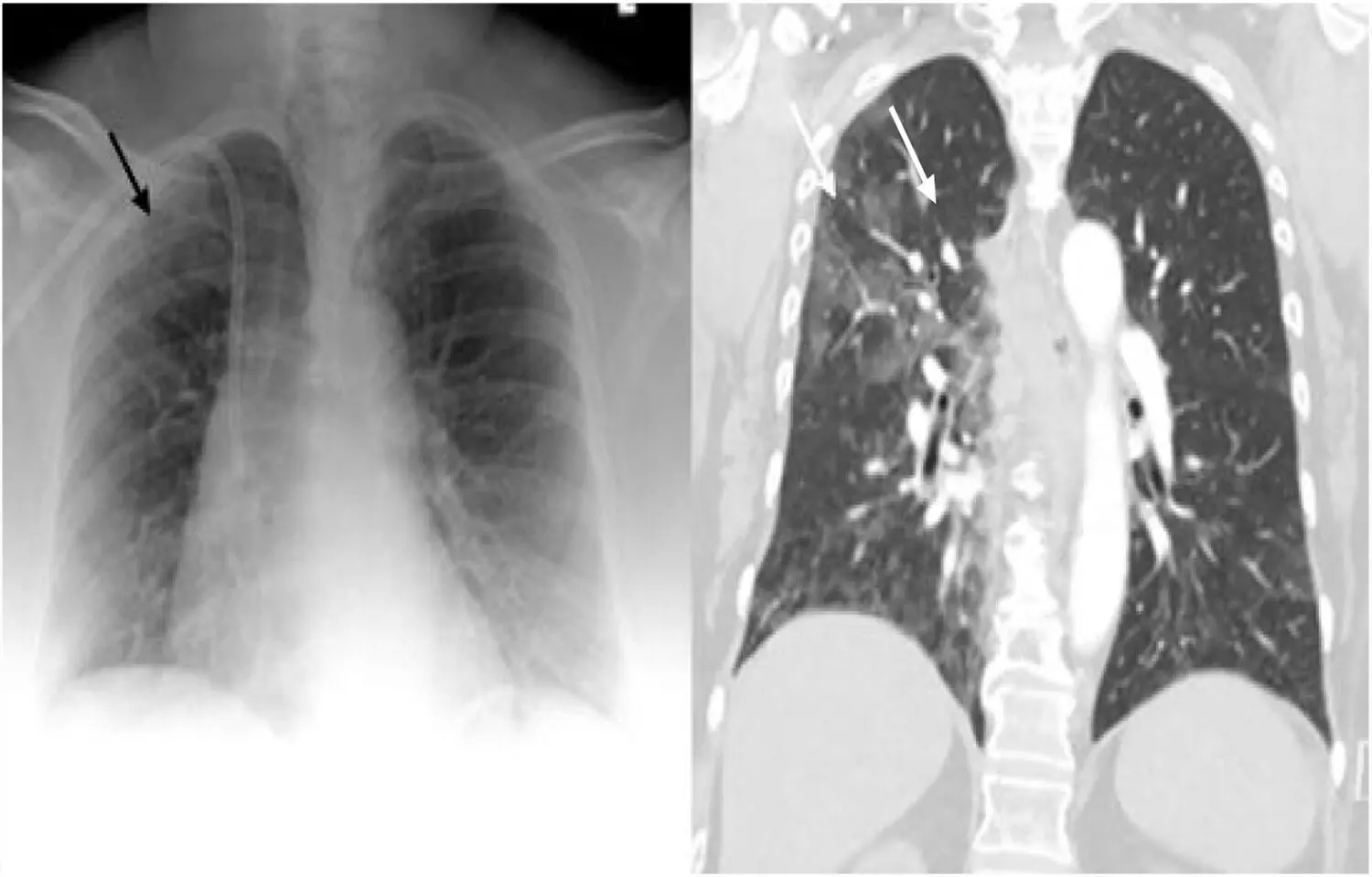 Projections on radiation dose tied to image quality during chest digital radiography: Study