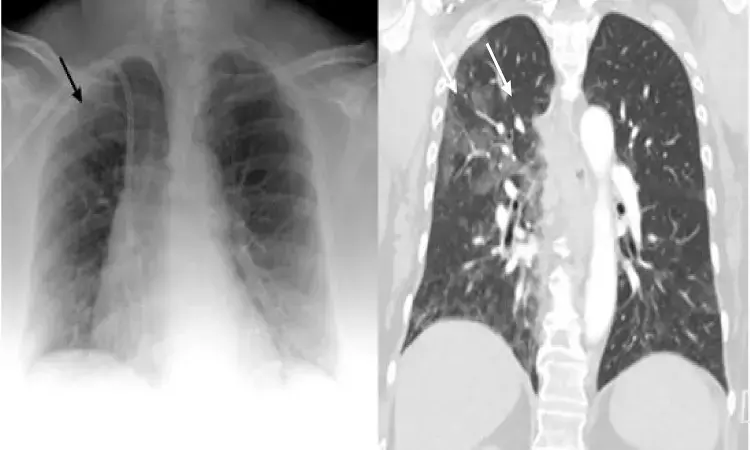 Chest radiography useful for early COVID detection, particularly in older adults: Study