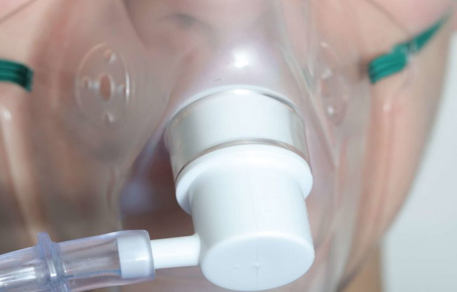 High Flow Oxygen Through Nasal Cannula Reduces Mechanical Ventilation   151252 Oxygen 1 