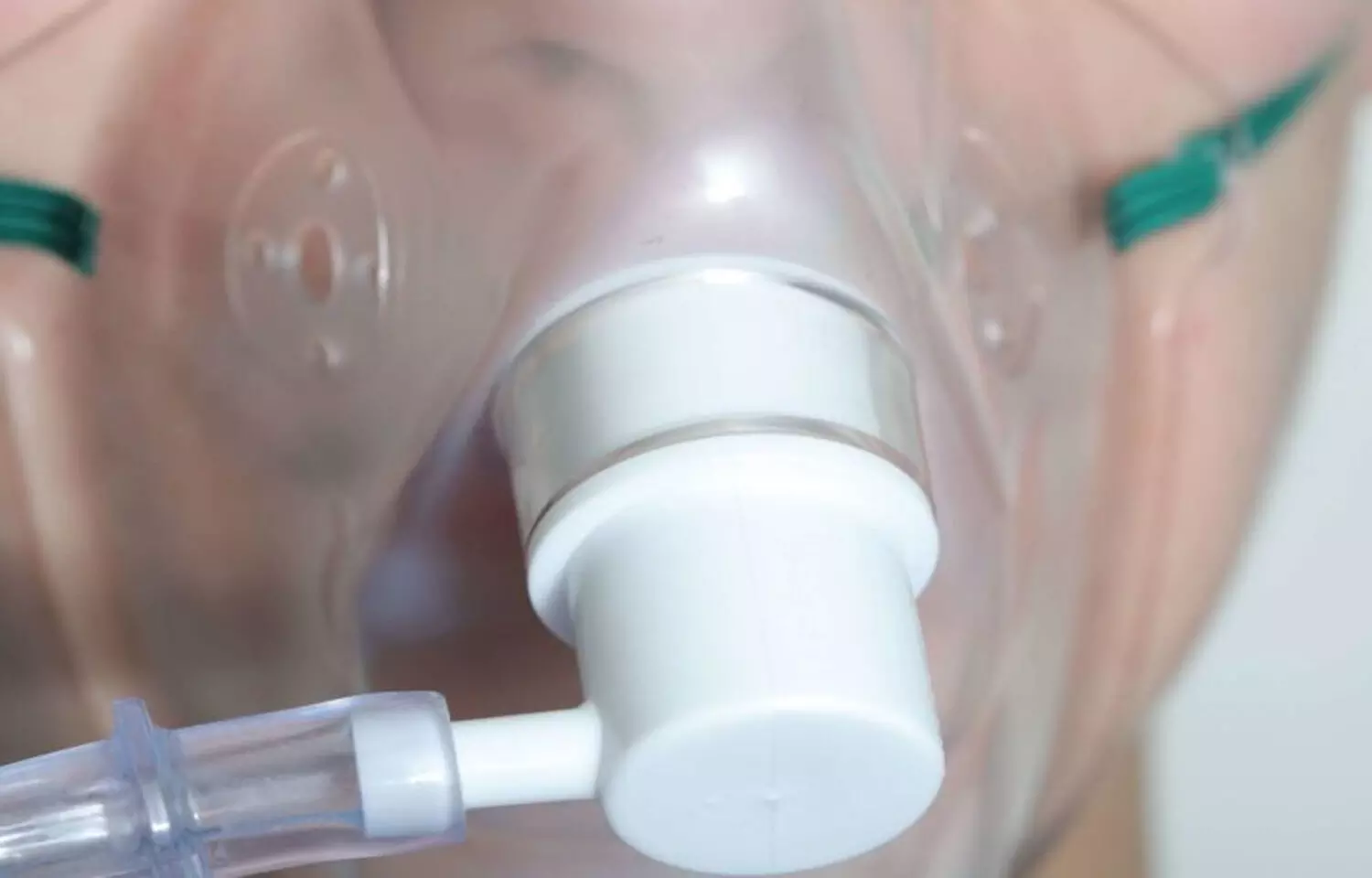 High-flow oxygen through nasal cannula reduces mechanical ventilation need in severe Covid-19: Study