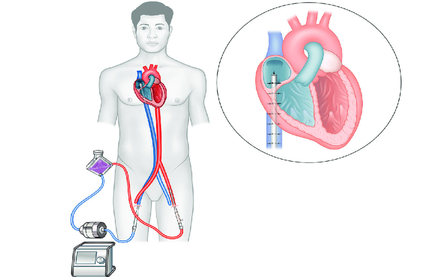 Earlier ECMO beneficial for patients with refractory cardiogenic shock ...