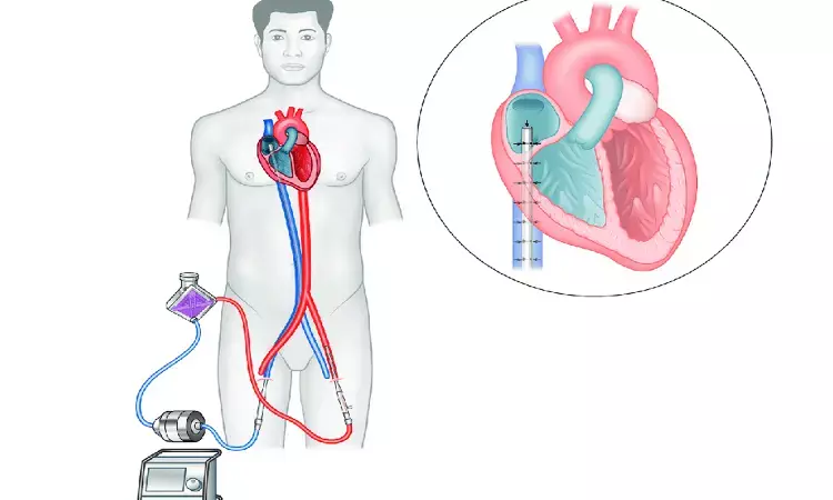 Earlier ECMO beneficial for patients with refractory cardiogenic shock: Study