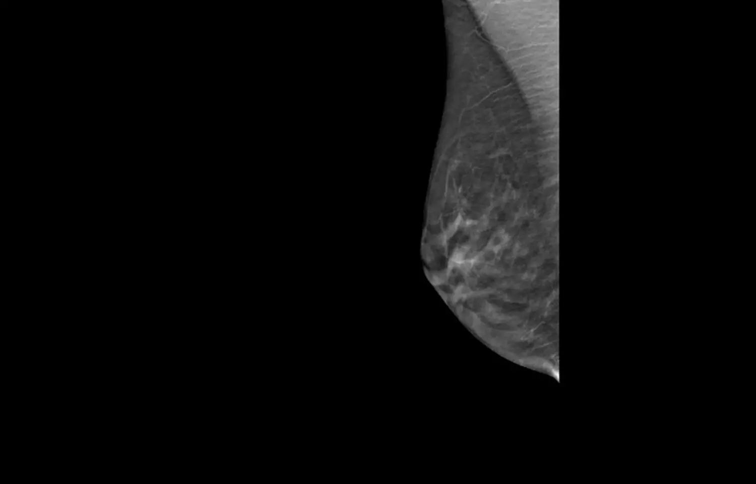 Ultrasound combined with DBT decreases mammography screening recall rate: Study