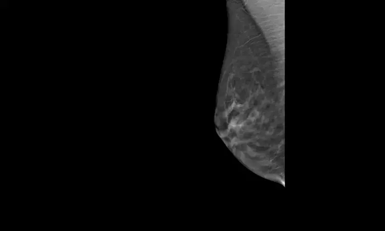 Ultrasound combined with DBT decreases mammography screening recall rate: Study