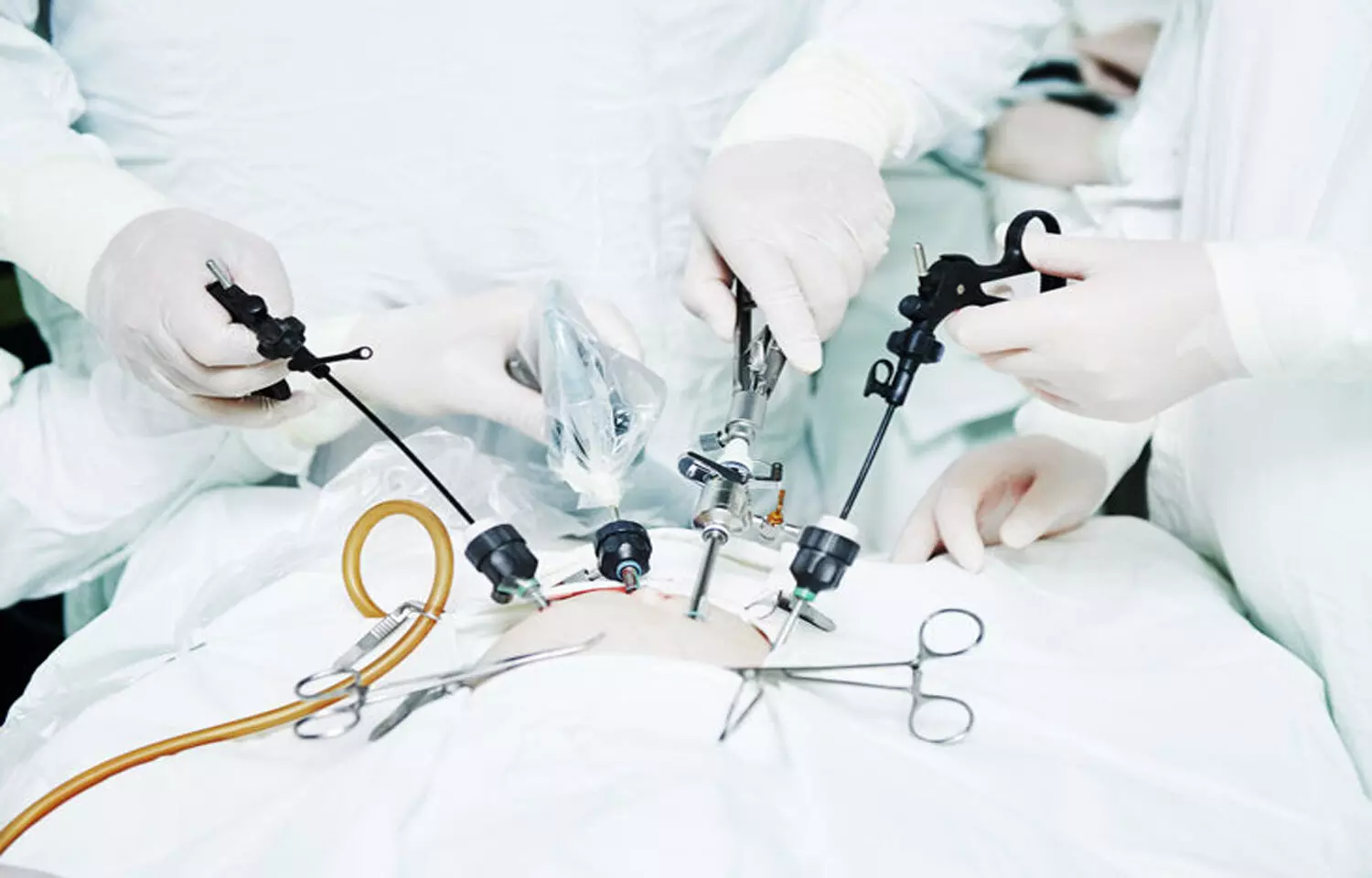 Laparoscopic surgery of inguinal hernia fails to outperform open repair under local anesthesia