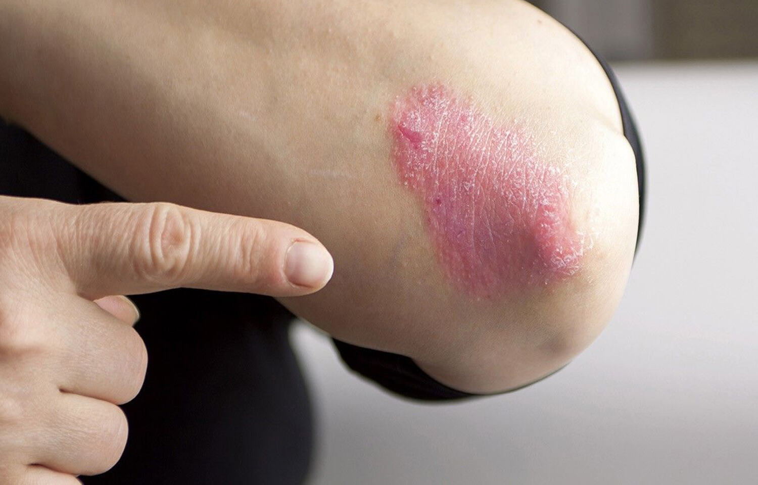 Roflumilast Cream Effective For Treating Plaque Psoriasis Jama