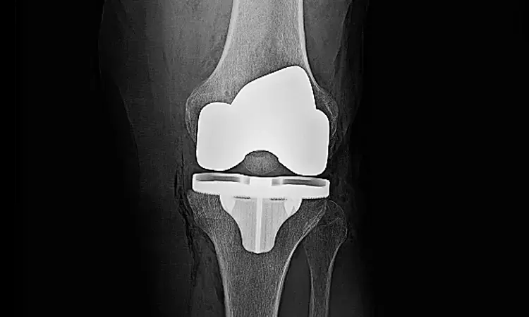 No Cement? No Problem. Uncemented Knee Replacement Could Last Longer