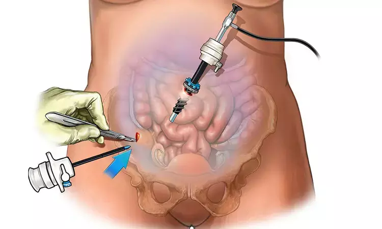 Laparoscopic repair using nonperfusion hysteroscopy tied to precise and  complete resection of cesarean scar defect