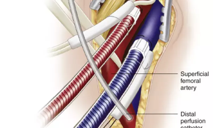 Femoral Arterial Cannulation Provides Excellent Results for Aortic Dissection Repair