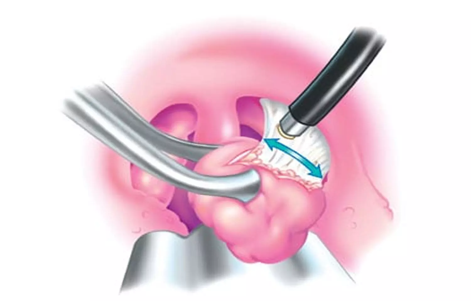 How to remove caseum from your tonsils 