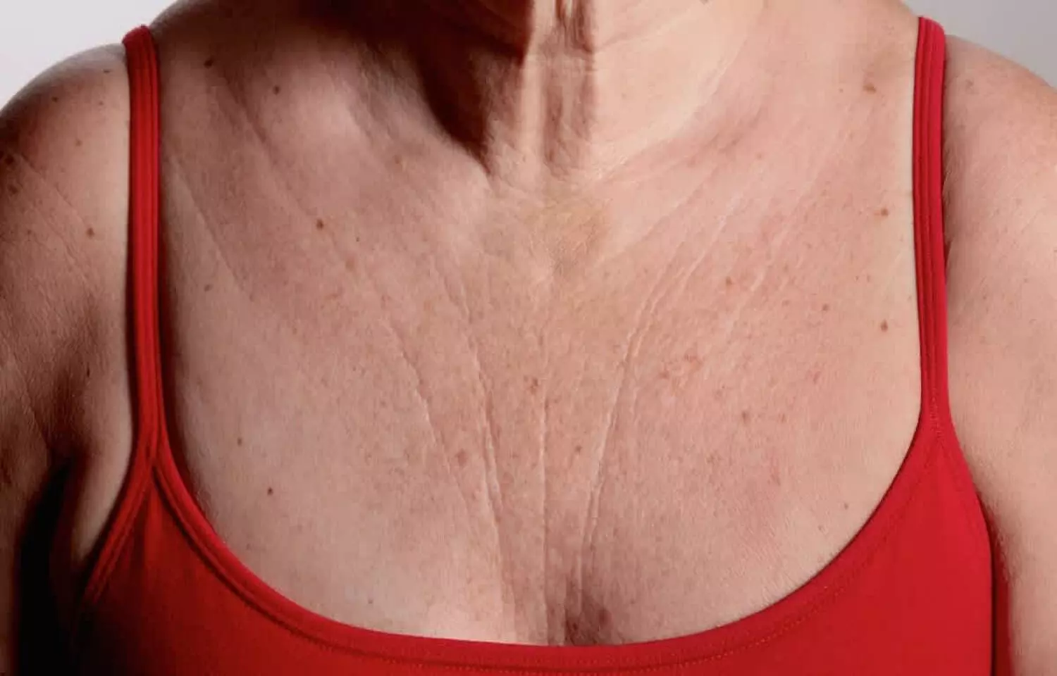 Calcium hydroxylapatite helps improve chest wrinkles in women: Study