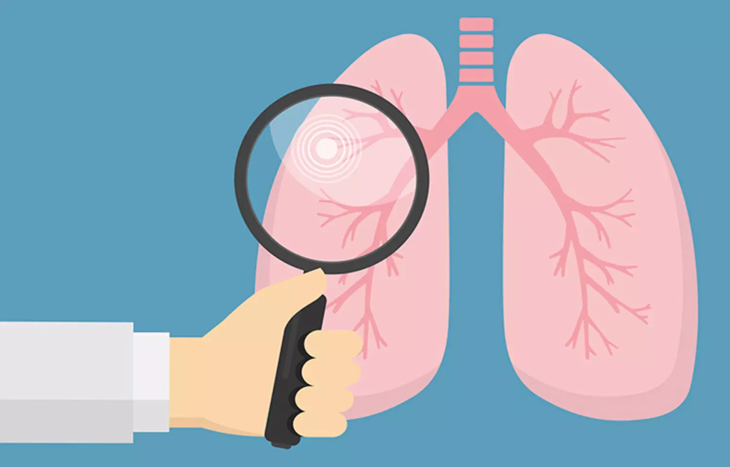 AI for predicting malignancy risk of pulmonary nodules detected at CT screening