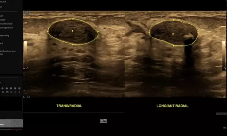 Artificial Intelligence Aids Radiologist to classify Masses in Breast Ultrasound