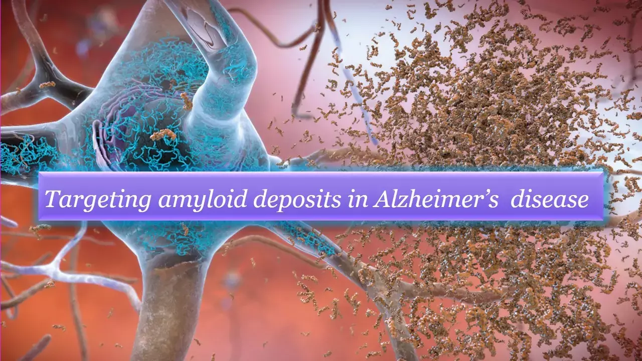 Novel drug targeting amyloid plaques offers tentative hope for Alzheimers patients, NEJM study