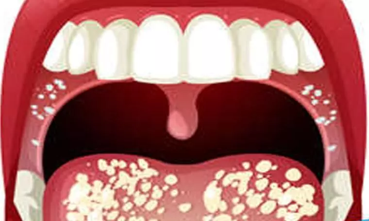 Oral lichen planus linked with reduced quality of life in patients, Study shows