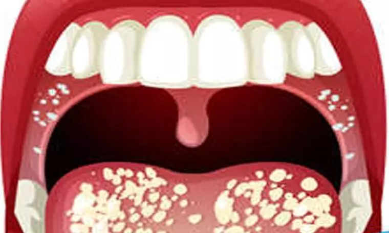 erosive lichen planus gingiva