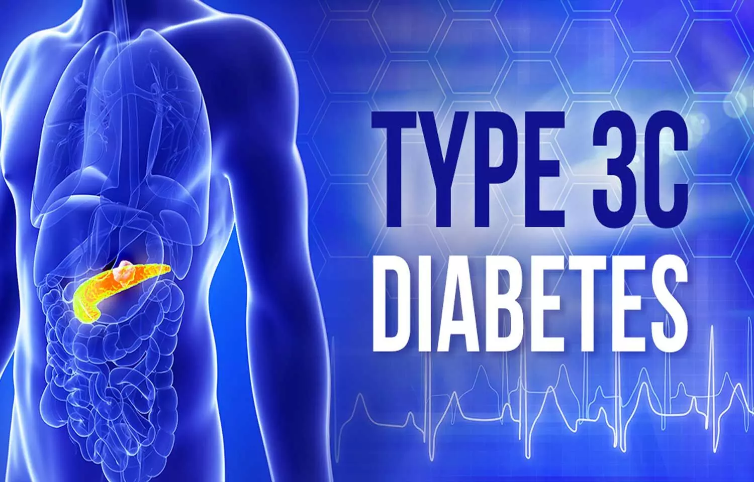 Blood sugar control may improve Hemifacial spasm in type 3c diabetes- Case Report