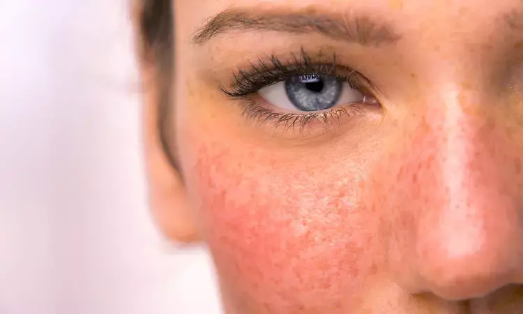 People with rosacea at higher risk of upper gastrointestinal disorders, study finds