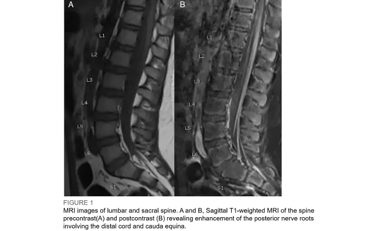 First case of COVID-19 presenting as Gullian- Barre syndrome