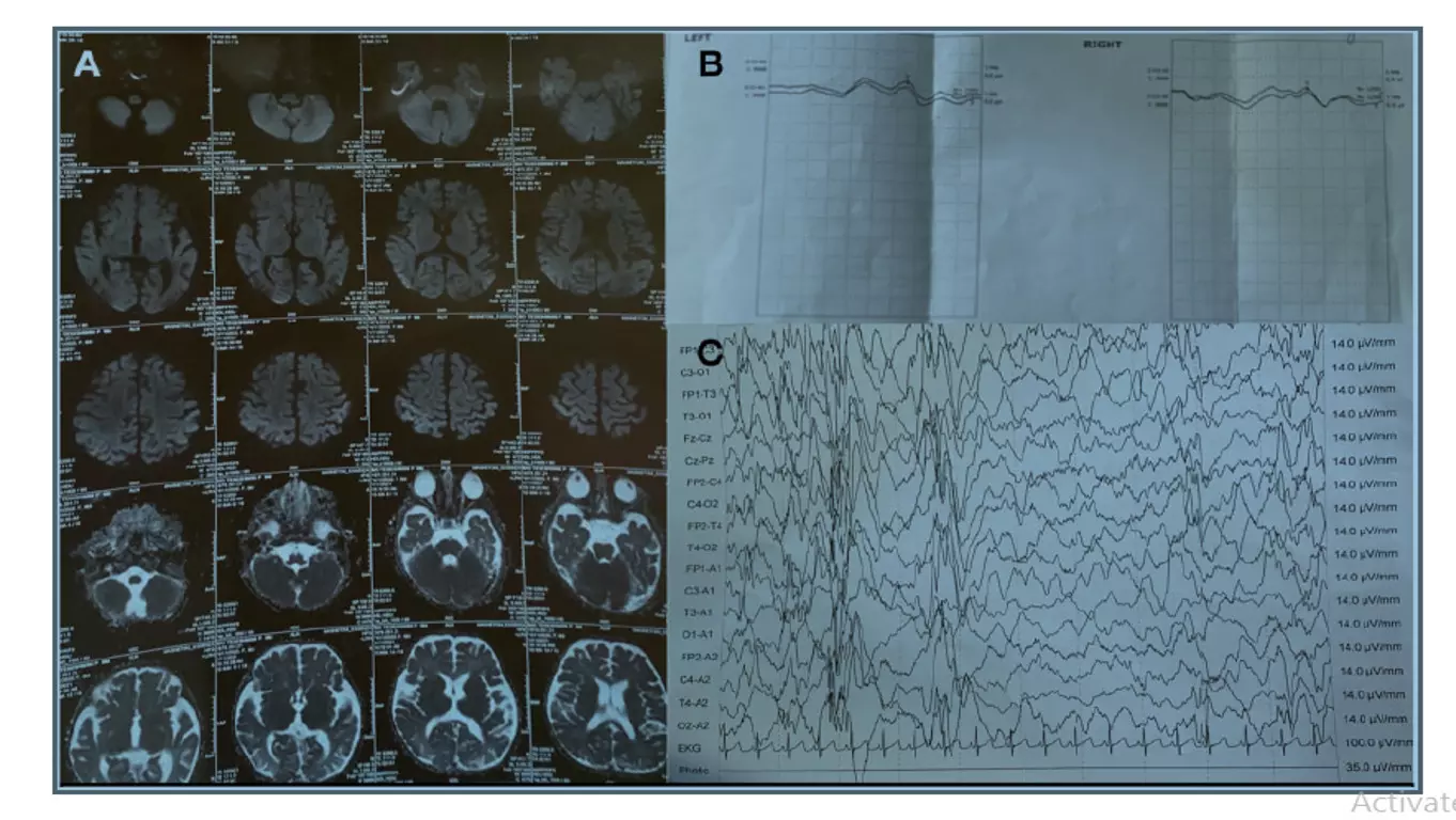 A rare case of severe COVID-19 progressing to secondary WEST syndrome: a case report