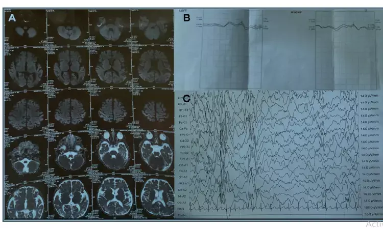 A rare case of severe COVID-19 progressing to secondary WEST syndrome: a case report