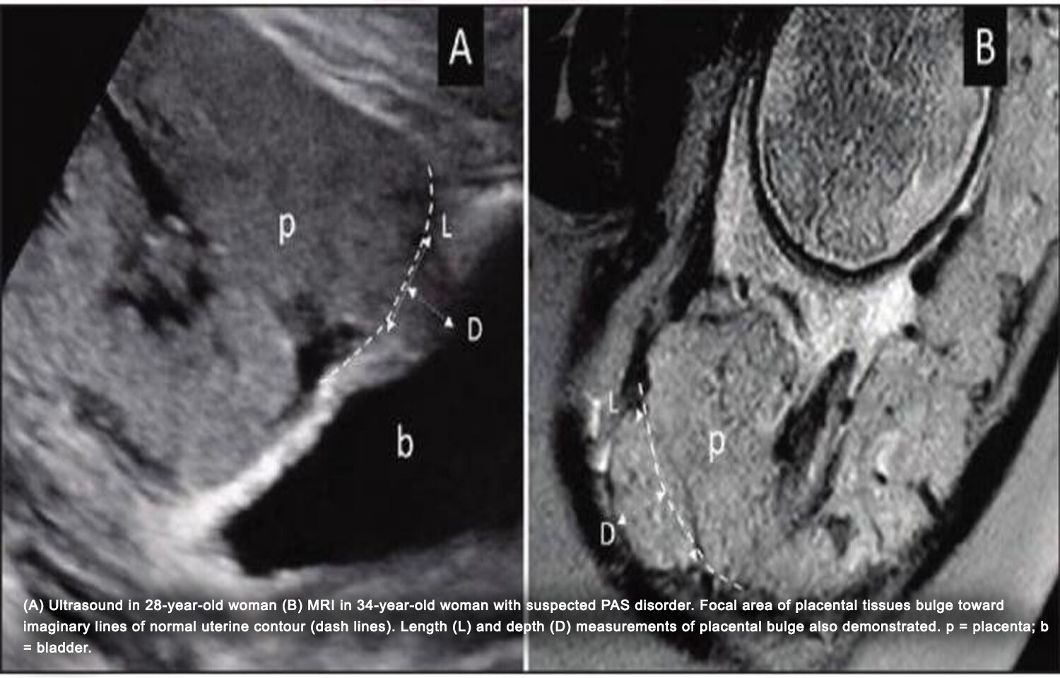 ultrasound-mri-may-help-in-diagnosis-of-placenta-accreta-spectrum