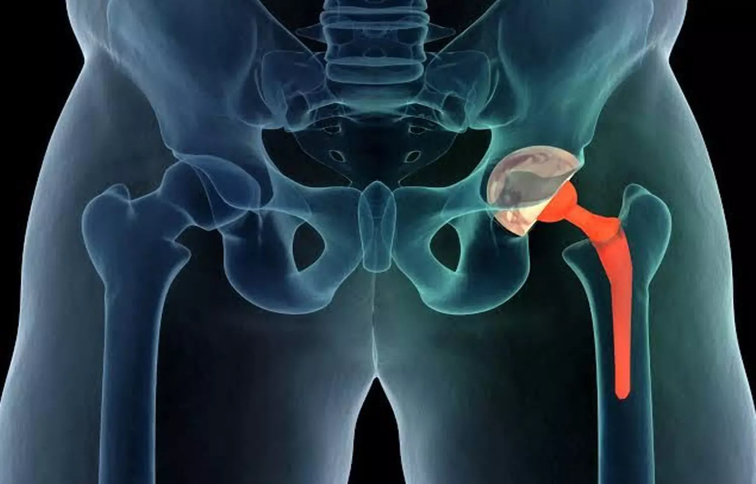 No benefit of quadratus lumborum block addition for managing pain after hip surgery: Study