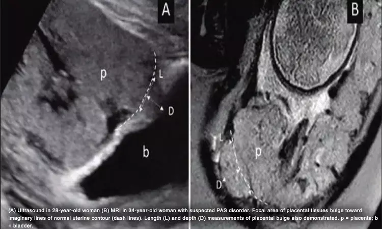 Ultrasound, MRI may help in diagnosis of placenta accreta spectrum disorder: Study