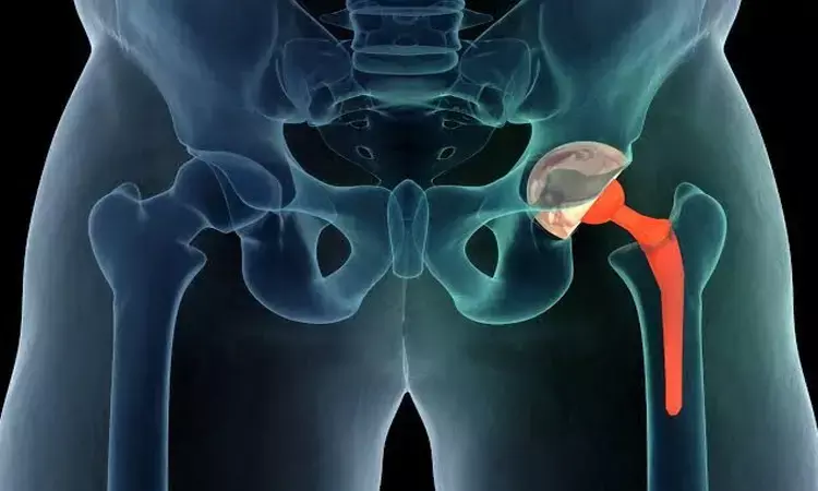 Constrained tripolar acetabular liner effective in patients with high risk of dislocation: Study