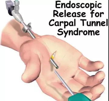 Endoscopic Versus Open Carpal Tunnel Release- outcomes in Carpal tunnel syndrome