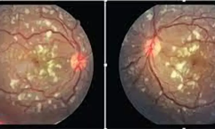 Purtscher Like Retinopathy in COVID-19 Patient: Hindawi Case Report
