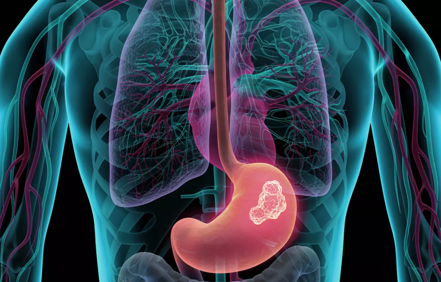 Autoimmune gastritis the driving factor in Young women towards Gastric Cancer: JAMA