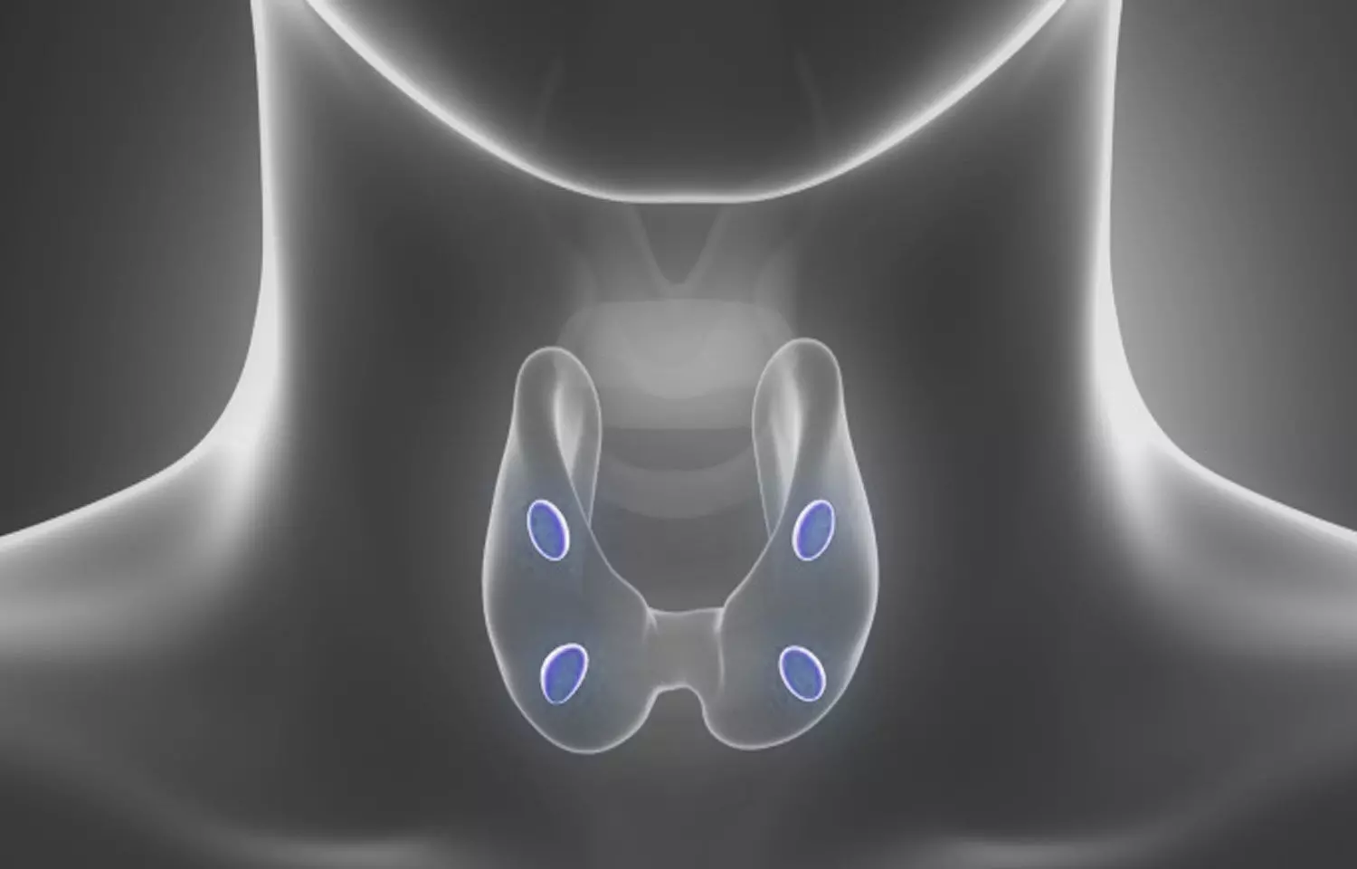 Surgery fails to reduce morbidity or mortality in mild hyperparathyroidism