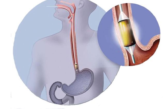 Barrett's neoplasia effectively managed with Radiofrequency ablation ...