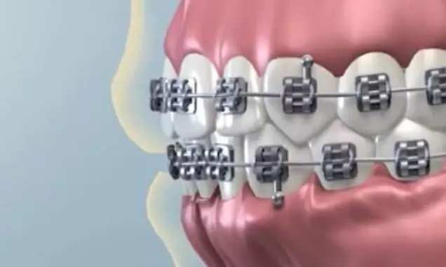 Removable appliances with temperature sensors effective in orthodontic patients