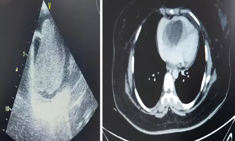 Doctors at Wockhardt Hospital Remove A Massive Heart Tumor To Save 28-Year-Old Womans Life