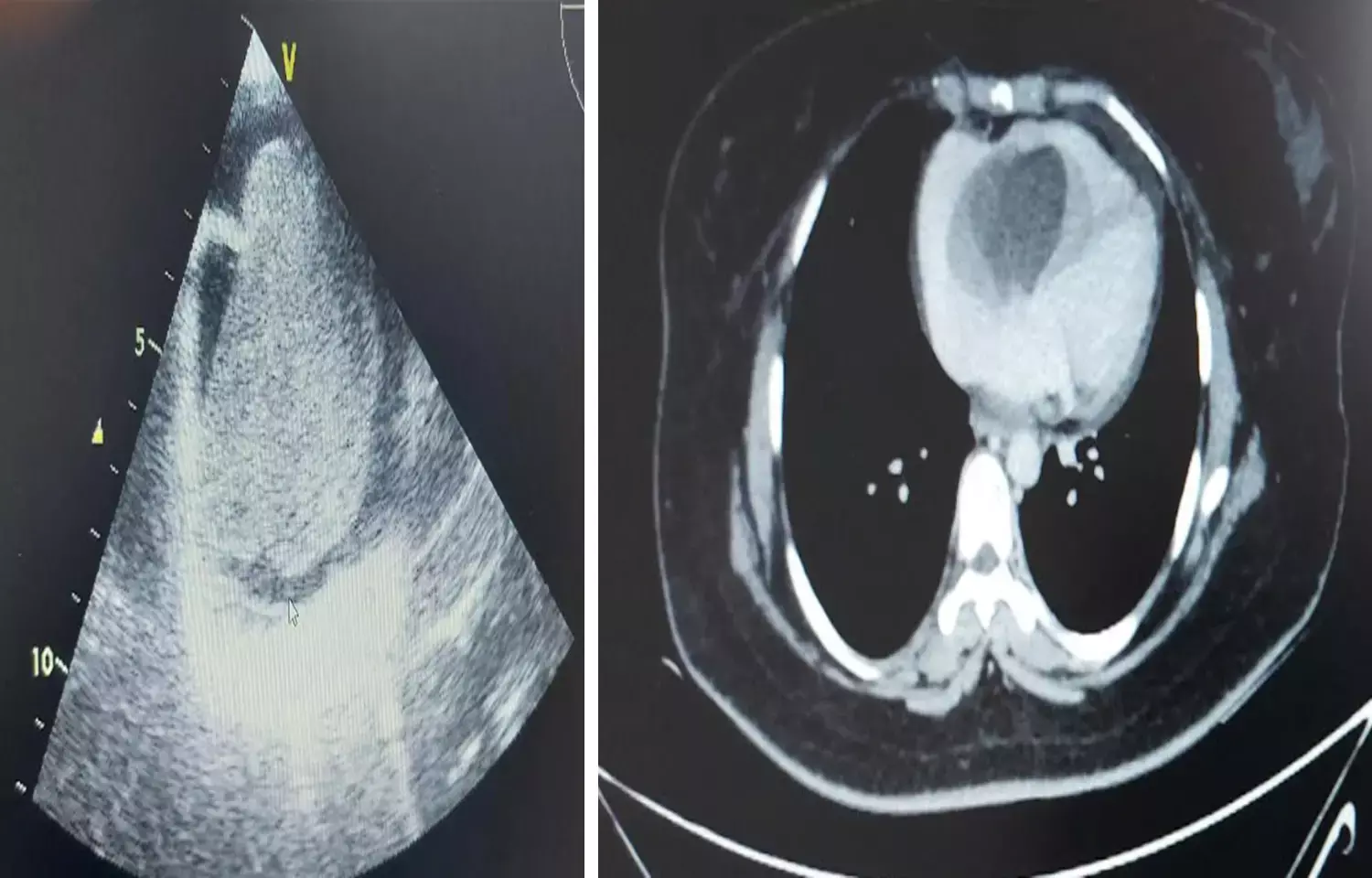 Doctors at Wockhardt Hospital Remove A Massive Heart Tumor To Save 28-Year-Old Womans Life