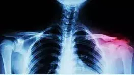 Patients of Medial clavicle fractures get relief by 1 year but have high mortality: Study