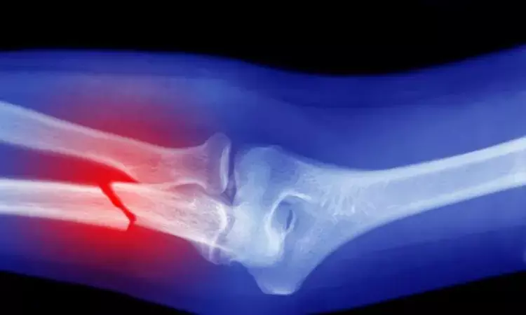 PGI Chandigarh Orthopaedicians innovative Pin breaks new ground in bone fracture treatment