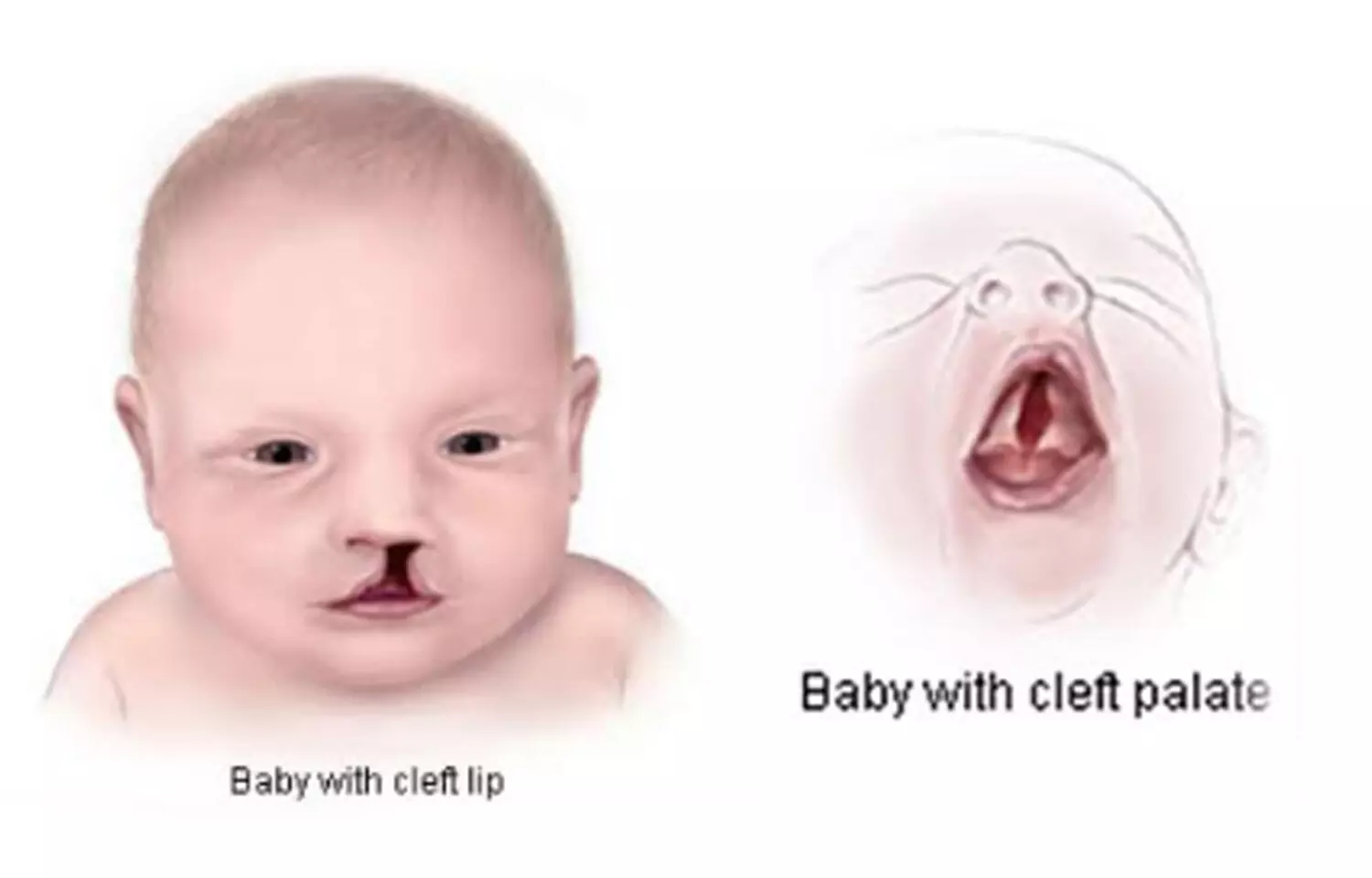 Occurrence of oral clefts linked to ABO, Rh blood groups, lip, dermatoglyphic patterns, Finds study
