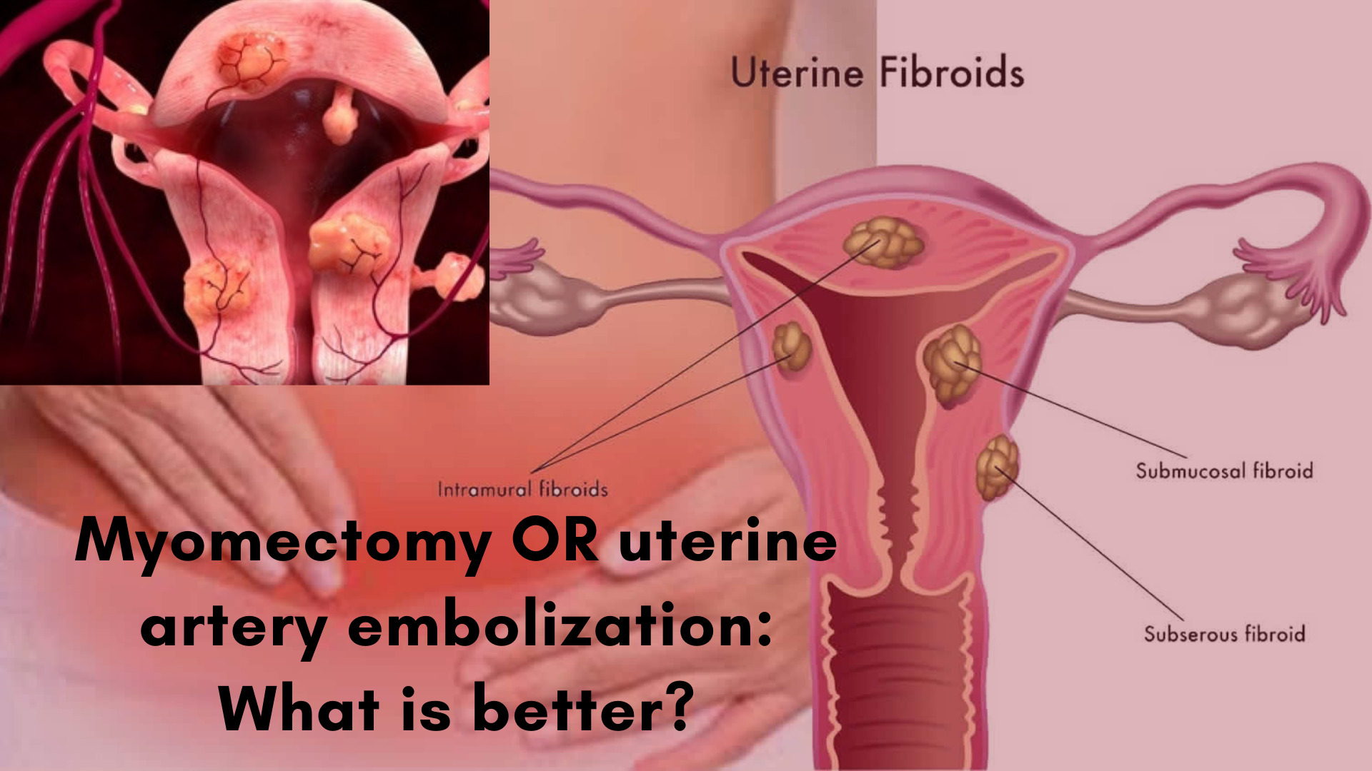 Myomectomy Yields Superior Health Related Quality Of Life To Uterine Artery Embolization Femme 