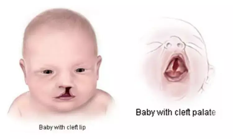 Occurrence of oral clefts linked to ABO, Rh blood groups, lip, dermatoglyphic patterns, Finds study
